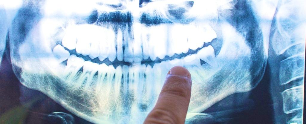 The reason for Alzheimer's reasons may come from the mouth: